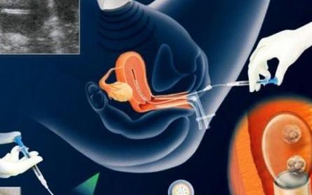 宜兴市人民医院试管婴儿技术好吗？宜兴市人民医院做试管需要花多少钱？